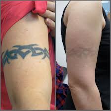 If you looking for tattoo removal instead of laser than salt and lemon juice is a perfect home. Laser Tattoo Removal Mystique Medical Day Spa