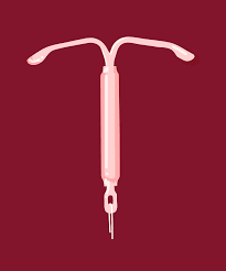 Mirena iud is used to prevent pregnancy for 6 years. Mirena Iud Removal Female Contraceptive Personal Story