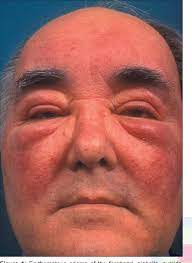 The revised ghent nosology for the marfan syndrome. Pdf Morbihan Syndrome Semantic Scholar