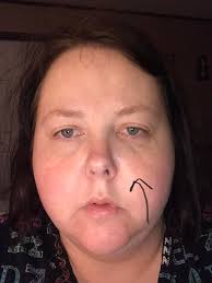 Please help!!! I had a tooth extracted two days ago and a abscess drained.  Today I'm in the worst pain ever goes this look like normal healing???