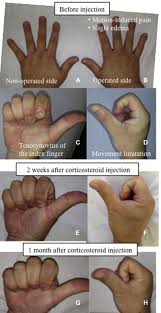 Running it under hot water actually works well.but that's the wrong approach. Early Detection And Treatment Of Complications In The Fingers And Hand After Arthroscopic Rotator Cuff Repair Sciencedirect