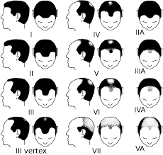 In the most common type of permanent hair loss, only the top of the head is affected. The Cause Of Male Hair Loss Hq Hair Transplants