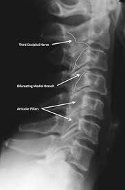 To perform, look straight ahead, then turn your head to your left side, stretching as far as you can to this side without pain. Facet Injections And Radiofrequency Denervation Radiology Key