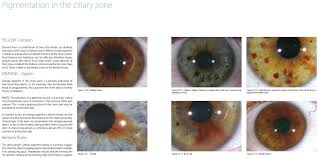 Pigmentation In The Ciliary Zone The Integrated Iridology