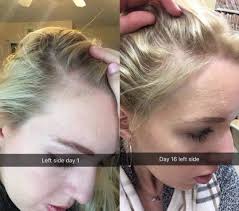 Chemotherapy may cause hair loss all over your body — not just on your scalp. 22 Products To Help You Take Care Of Your Scalp