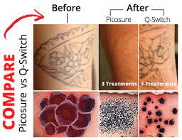 Storwick dermatology & laser clinic. Laser Tattoo Removal Skinpossible Medical Aesthetics Clinic