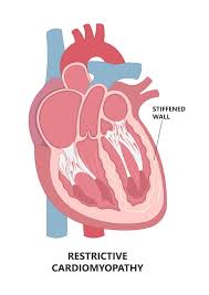 Image result for Restrictive Cardiomyopathy