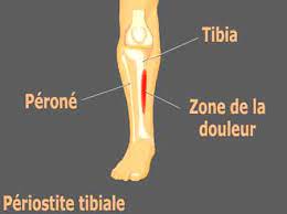Le terme priostite tibiale dsigne toutes sortes de douleurs inflammatoires aigues le long du bord interne du tibia. Periostite Tibiale Etirements Et Massages Efficaces