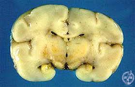 Image result for Kernicterus