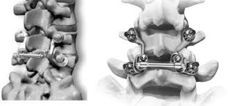 Intervertebral Disc Joint Replacement Technology Sciencedirect