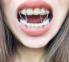 Braces Girlswithbraces Clearbraces Elastics Powerchain Dental Braces Braces Tips Teeth Braces