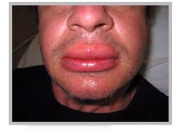 Suspected anaphylactic reactions associated with anaesthesia. Resuscitation Council Uk Advanced Life Support Treating A Patient With Anaphylaxis