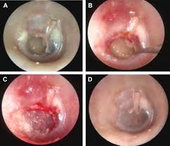 Image result for Myringosclerosis