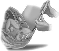 Image result for Forceps Assisted Delivery