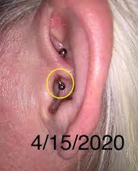 Daith Piercing For Migraines One Year In Dandelion Max