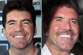 Read about different types of false teeth cost and which is right for you. As Simon Cowell Shows Off Gleaming Teeth Other Celebs Who Ve Transformed Their Smile Mirror Online