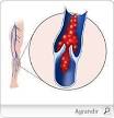 Phlbite - Dfinition, Symptmes, Signes, Causes - Sant Pratique