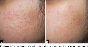 Figure 3 From Retinoic Acid And Glycolic Acid Combination In The Treatment Of Acne Scars Semantic Scholar