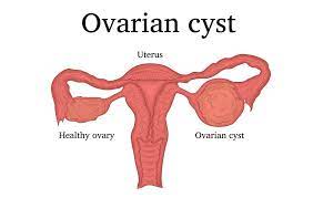 Ovarian Cyst Symptoms - How To Know If You Have An Ovarian Cyst