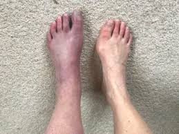 Crps Complex Regional Pain Syndrome Successful Treatment To Recovery Uk London