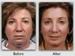 Before And After Plastic Surgery At The Miami Institute Plastic Surgery Cosmetic Surgery Surgery
