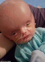 Baby Born With A Swollen Head Defies Doctors Who Told His Mother To Terminate Pregnancy Daily Mail Online