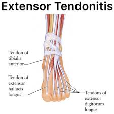 This post explains the causes, treatment, and recovery time of this condition. Extensor Tendonitis Tendinopathy Sports Physiotherapy Stefan Duell Facebook
