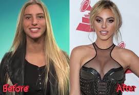 Lele Pons Nose Job Lele S Path From Youtube To Beauty Queen Nose Job Lele Pons Nose Job Lele Pons Nose