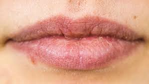 Image result for Lip Cancer