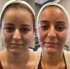 Orjinal Alman Adela Cross Fethiye de sadece Pınar Pınar estetik ve sağlıklı  yaşam merkezinde📣📣📣📣 ••••••••••••••••••••••••••••••••••••••• ❄️Buz  başlık ile AĞRISIZ ACISIZ epilasyon keyfi ———————————————— ✓ Maksimum 4  SEANS ile 6 SEANS arası ...