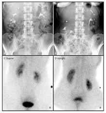 Image result for Intravenous Pyelogram