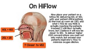 This device consists of a lightweight tube which on one end splits into two prongs which are placed in the nostrils and from which a mixture of air and oxygen. High Flow Nasal Cannula Hfnc Part 1 How It Works Rebel Em Emergency Medicine Blog