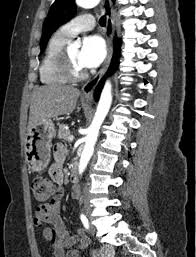 Image result for Myelitis