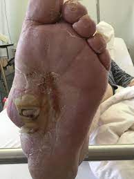 .patients atteints d'arthropathie diabétique de charcot et examiner la pathophysiologie et les caractéristiques cliniques et radiographiques de l'arthropathie de charcot. Charcot Fuss Diabetischer Fuss Mit Spontanbruchen Bei Polyneuropathie