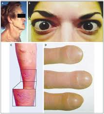 Understanding Pathogenesis Intersects With Effective Treatment for Thyroid  Eye Disease