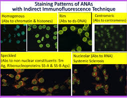 Image result for ANA Staining Pattern