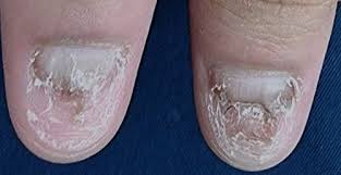 Image result for Onychotillomania feet