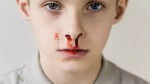 Image result for Epistaxis