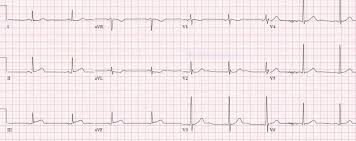 Yine bir akut koroner sendrom olan unstable angina ile nstemi , cardiac markerlara bakıldıktan sonra ayırt edilebilir. Subtle Inferior Mi Ecg Cases Em Cases