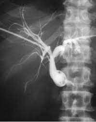 Acronyms and abbreviations are used extensively in medicine, science and technology for good reason — they are more essential in such fields. External Biliary Drainage Catheter Placed With Common Bile Duct Cbd Download Scientific Diagram