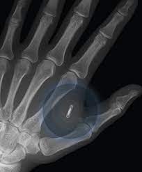 Pentru prima generatie de proteze neuronale, cipul va trebui sa fie implantat in creier pe cale chirurgicala de catre un neurolog, dar johnson isi doreste ca in. Despre Cipul Din Mana Mea George Buhnici