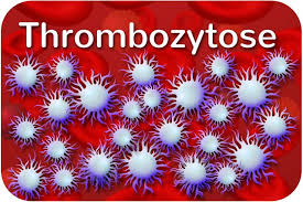 Immunthrombozytopenische purpura, hypersplenie (erhöhte ablagerung in dermilz). Thrombozytose Zu Viele Thrombozyten