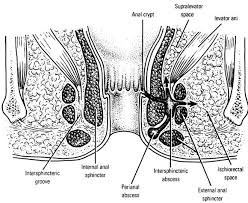 Image result for Ischiorectal Abscess