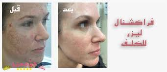 فراكشنال ليزر للوجه و المسامات الاثار الجانبية و تجربتي قبل و بعد مع الفراكشنال Fractional Laser Fractional Laser Laser Incoming Call Screenshot
