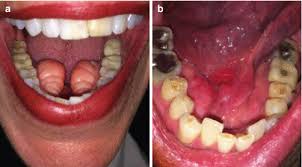 Image result for Submandibular Exam