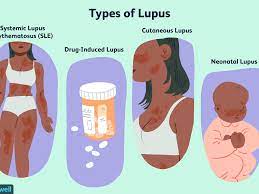 I am now aged 26, living life without any signs of lupus activity. Lupus Treatment Options