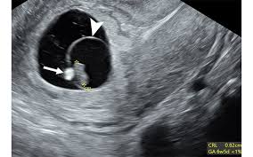 Image result for First Trimester Ultrasound