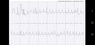 Ekg l supraventricular tachycardia (svt). Who Can Help Me Determine This Kardia Ecg I Think I Might Have Svt Atrialfibrillation