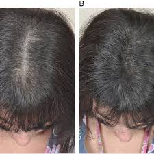 Tropic isle living jamaican black castor oil is an excellent product to use for this. A Androgenetic Alopecia Thinning Of The Crown And Frontal Scalp Download Scientific Diagram