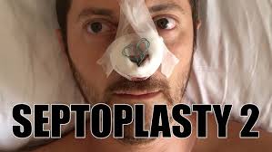 SEPTOPLASTY PART II